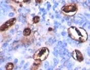 IHC: Formalin-fixed, paraffin-embedded human colon carcinoma stained with CA19-9 antibody (SPM588).