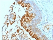 IHC: Formalin-fixed, paraffin-embedded human colon carcinoma stained with Blood Group Lewis a antibody (SPM279).