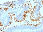 IHC: Formalin-fixed, paraffin-embedded human colon carcinoma stained with Blood Group Lewis a antibody (SPM522).