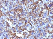 IHC: Formalin-fixed, paraffin-embedded human Histiocytoma stained with Macrophage antibody (D11).