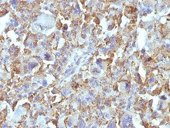 IHC: Formalin-fixed, paraffin-embedded human Histiocytoma stained with Macrophage antibody (D11).~