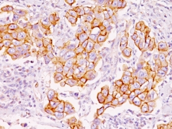 IHC: Formalin-fixed, paraffin-embedded human breast carcinoma stained with Phosphotyrosine antibody (clone PY793).~