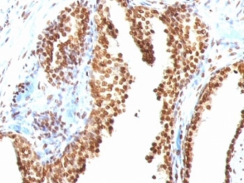IHC staining of FFPE human colon carcinoma with dsDNA antibody (clone AE-2). HIER: boil tissue sections in pH 9 10mM Tris with 1mM EDTA for 10-20 min and allow to cool before testing.~