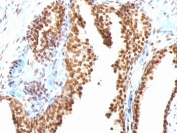 IHC staining of FFPE human colon carcinoma with dsDNA antibody (clone AE-2). HIER: boil tissue sections in pH 9 10mM Tris with 1mM EDTA for 10-20 min and allow to cool before testing.