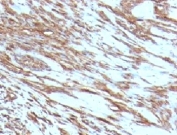 IHC: Formalin-fixed, paraffin-embedded human leiomyosarcoma stained with pan Muscle Actin antibody (clone MSA/953).