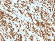 IHC: Formalin-fixed, paraffin-embedded human rhabdomyosarcoma stained with pan Muscle Actin antibody (clone MSA/953).