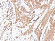 IHC: Formalin-fixed, paraffin-embedded human leiomyosarcoma stained with pan Muscle Actin antibody