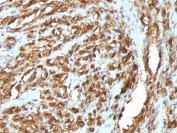 IHC: Formalin-fixed, paraffin-embedded human rhabdomyosarcoma stained with pan Muscle Actin antibody (HHF35 + MSA/953)