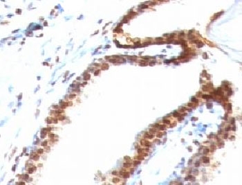 IHC: Formalin-fixed, paraffin-embedded human colon carcinoma stained with Double Stranded DNA antibody (clone DSD/958).~