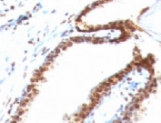 IHC: Formalin-fixed, paraffin-embedded human colon carcinoma stained with Double Stranded DNA antibody (clone DSD/958).