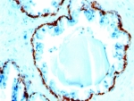 IHC: Formalin-fixed, paraffin-embedded human prostate carcinoma stained with Basic Cytokeratin antibody (SPM591).