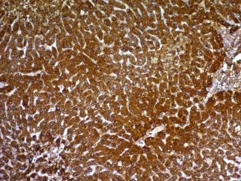 IHC: Formalin-fixed, paraffin-embedded human hepatocellular carcinoma stained with HepPar1 antibody.