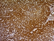 IHC: Formalin-fixed, paraffin-embedded human hepatocellular carcinoma stained with HepPar1 antibody (clone HepPar1).