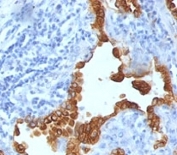IHC analysis of formalin-fixed, paraffin-embedded human lung carcinoma stained with Cytokeratin 8/18 antibody (clone SPM141).