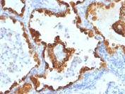 IHC: Formalin-fixed, paraffin-embedded human lung carcinoma stained with Cytokeratin 8/18 antibody (C-43 + DC10).