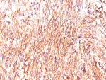 IHC: Formalin-fixed, paraffin-embedded human GIST stained with DOG1 antibody (clone DOG1.1).