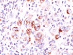 IHC: Formalin-fixed, paraffin-embedded human Hodgkin's lymphoma stained with Bcl-x antibody (2H12). Note cytoplasmic and membrane staining.
