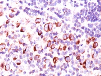 IHC: Formalin-paraffin Hodgkin's lymphoma stained with Bcl-x antibody (BX006 + 2H12).~