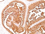 IHC analysis of formalin-fixed, paraffin-embedded human breast carcinoma stained with MUC-1 antibody (clone E29).