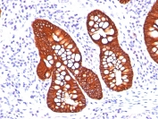 IHC: Formalin-fixed, paraffin-embedded human colon carcinoma stained with Cytokeratin 19 antibody (A53-B/A2.26 + BA17).
