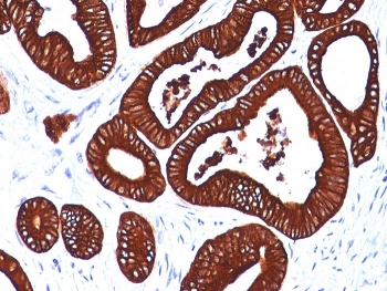 IHC analysis of formalin-fixed, paraffin-embedded human colon carcinoma stained with Keratin 19 antib