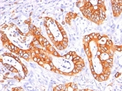 IHC: Formalin-fixed, paraffin-embedded human colon carcinoma stained with MUC-1 / EMA antibody cocktail (clones GP1.4 + E29).