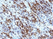 IHC: Formalin-fixed, paraffin-embedded human Rhabdomyosarcoma stained with Myogenin antibody cocktail (clones MGN185 + F5D). Required HIER: boil tissue sections in 10mM citrate buffer, pH6, for 10-20 min followed by cooling at RT for 20 min.