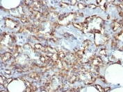 IHC analysis of formalin-fixed, paraffin-embedded human angiosarcoma stained with CD31 antibody (clone JC/70A).