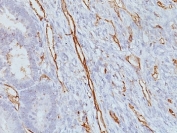 IHC analysis of formalin-fixed, paraffin-embedded human colon carcinoma stained with CD31 antibody (clone JC/70A).