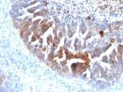 IHC: Formalin-fixed, paraffin-embedded human ovarian carcinoma stained with TAG-72 antibody (B72.3 + CC49).
