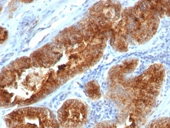 IHC: Formalin-fixed, paraffin-embedded human prostate carcinoma stained with TAG-72 antibody (B72.3 + CC49).~