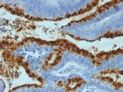IHC staining of FFPE human colon carcinoma with FUT3 antibody (clone SPM194).