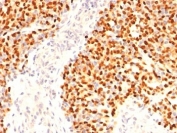 IHC: Formalin-fixed, paraffin-embedded human Rhabdomyosarcoma stained with Myogenin antibody (F5D)