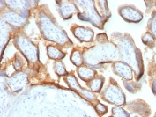 IHC: Formalin-fixed, paraffin-embedded human placenta stained with hCG beta antibody (HCGb/54 + HCGb/459).