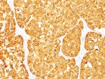 IHC: Formalin-fixed, paraffin-embedded human melanoma stained with MART-1 / Melan-A antibody (M2-7C10 + M2-9E3).