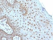 IHC: Formalin-fixed, paraffin-embedded human cervical carcinoma stained with c-Myc antibody (MYC275).