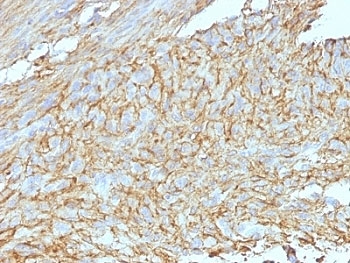IHC: Formalin-fixed, paraffin-embedded human GIST stained with DOG1 antibody cocktail.