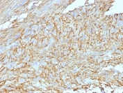 IHC: Formalin-fixed, paraffin-embedded human GIST stained with DOG1 antibody (DG1/447 + DOG-1.1).