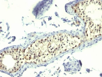 IHC: Formalin-fixed, paraffin-embedded human testicular carcinoma stained with Thymidylate Synthase antibody (TS106).~