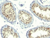IHC: Formalin-fixed, paraffin-embedded human testicular carcinoma stained with Thymidylate Synthase antibody (clones TS106 + TMS715).