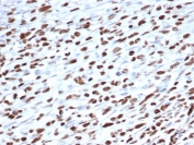 IHC staining of FFPE human Rhabdomyosarcoma with MyoD1 antibody (clone 5.8A). HIER: boil tissue sections in pH 9 10mM Tris with 1mM EDTA for 20 min and allow to cool before testing.