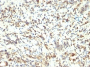 IHC staining of FFPE human Rhabdomyosarcoma with MyoD1 antibody (clone 5.8A). HIER: boil tissue sections in pH 9 10mM Tris with 1mM EDTA for 20 min and allow to cool before testing.