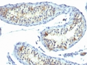 IHC: Formalin-fixed, paraffin-embedded human testicular carcinoma stained with Prolactin Receptor antibody (clone B6.2).