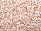 IHC: Formalin-fixed, paraffin-embedded human pituitary gland stained with ACTH antibody (AH26 + 57). Required HIER: boil tissue sections in 10mM Citrate Buffer, pH 6.0, for 10-20 min followed by cooling at RT for 20 minutes.
