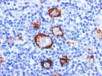 Formalin-fixed, paraffin-embedded human Hodgkin's lymphoma stained with CD15 antibody (Leu-M1).