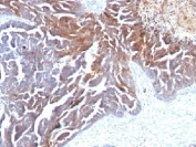 IHC analysis of formalin-fixed, paraffin-embedded human ovarian carcinoma stained with TAG-72 antibody (clone CC49).