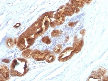 IHC analysis of formalin-fixed, paraffin-embedded human prostate carcinoma stained with TAG-72 antibody (clone CC49).~