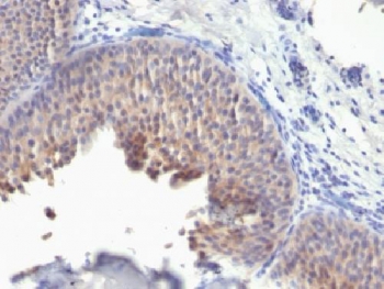 Formalin-fixed, paraffin-embedded human bladder carcinoma stained with anti-Keratin 10 antibody (KRT10/1275).~