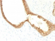 Formalin-fixed, paraffin-embedded human prostate carcinoma stained with E-Cadherin antibody (CDH1/1525).