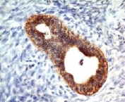 Formalin-fixed, paraffin-embedded human colon carcinoma stained with E-Cadherin antibody (CDH1/1525).